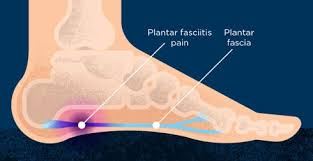 plantar fasciitis