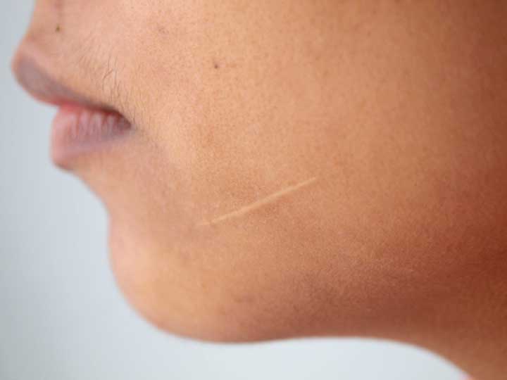 Scar treatment