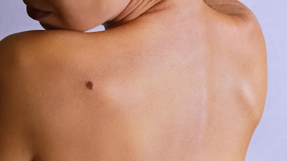 What are warts?