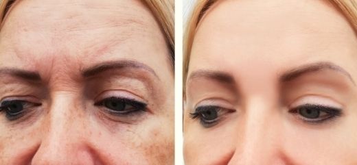 Antes y después Microneedling PRP