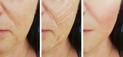 Antes y después Microneedling PRP