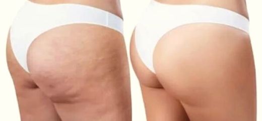 Antes y después del Tratamiento de mesoterapia corporal