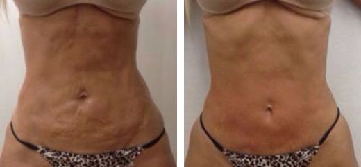 Antes y después del tratamiento con laser en el abdomen TightSculpting